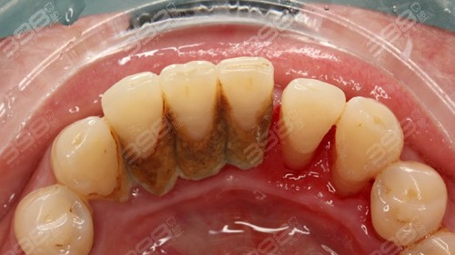 牙结石造成的牙缝大