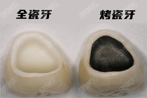广州烤瓷牙与全瓷牙的价格