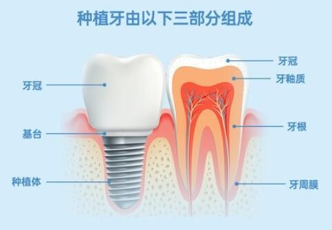 哈尔滨种牙多少钱?你知道哪家医院种植牙技术好价格还便宜吗?