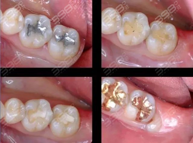嵌体和树脂补牙有什么区别？