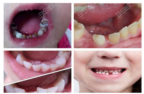 儿童牙齿各类疾病