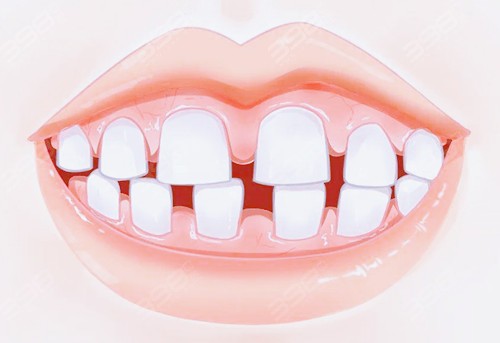 牙缝大怎么修复好?三十多岁牙齿缝隙变大一定要用这种方法!