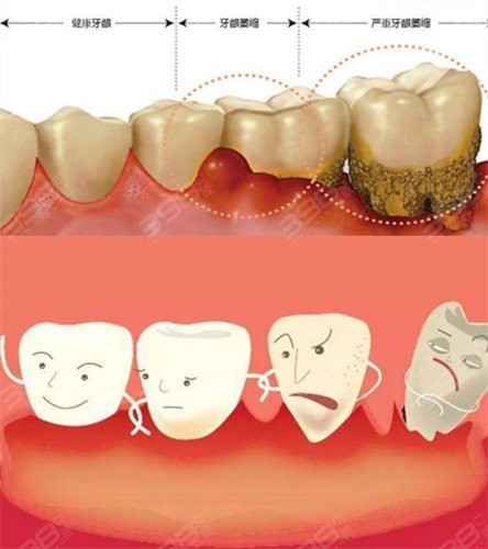 牙龈萎缩危害有哪些