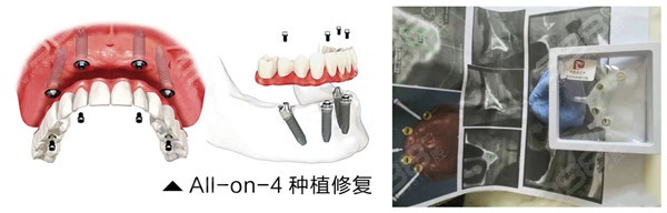 上海半口牙齿种植需要多少钱