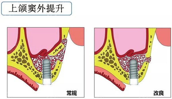 上颌窦内提升和外提升的区别
