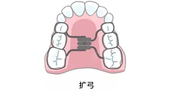 牙齿拥挤 扩弓和拔牙哪个矫正好 (3).jpg