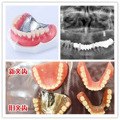 全口牙缺失修复用哪种方法好