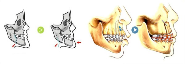 正颌和正畸的区别