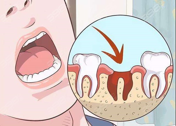 拔牙后多久能戴隐形义齿？后牙隐形义齿能吃饭吗？