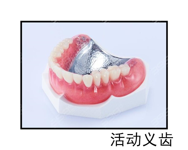 杭州镶假牙多少钱一颗？