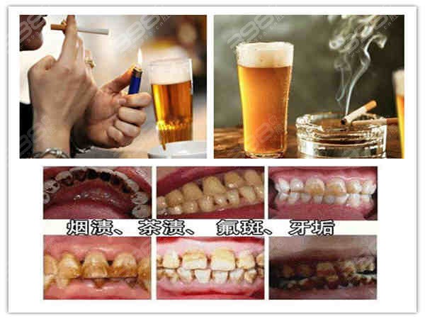 喝酒吸烟导致牙齿发黄