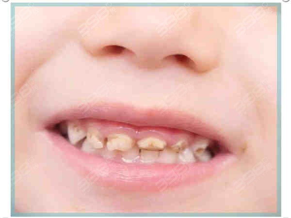 牙齿健康的因素导致牙黄