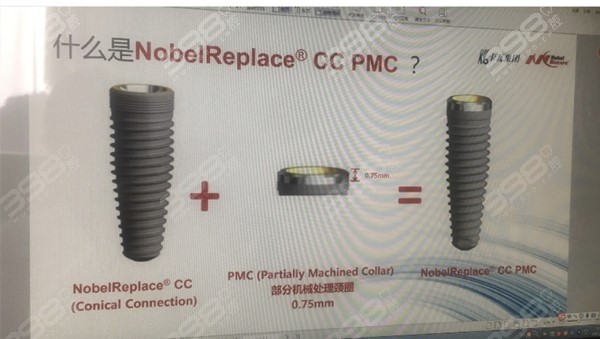 跪求：诺贝尔pmc种植体和pcc哪个好？原来诺贝尔pmc和pcc价格区别这么大