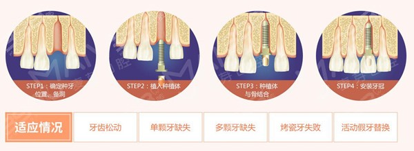 种植牙流程