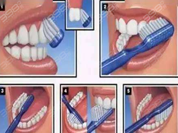 戴牙套刷牙的顺序