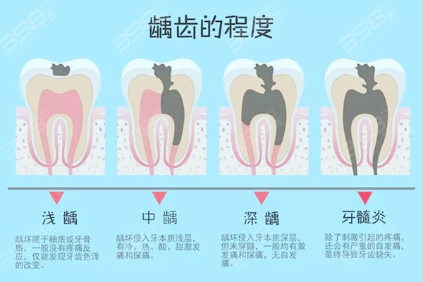 龋齿的发展过程图片