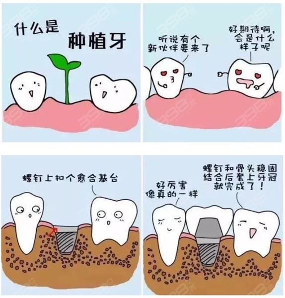 种植牙原理