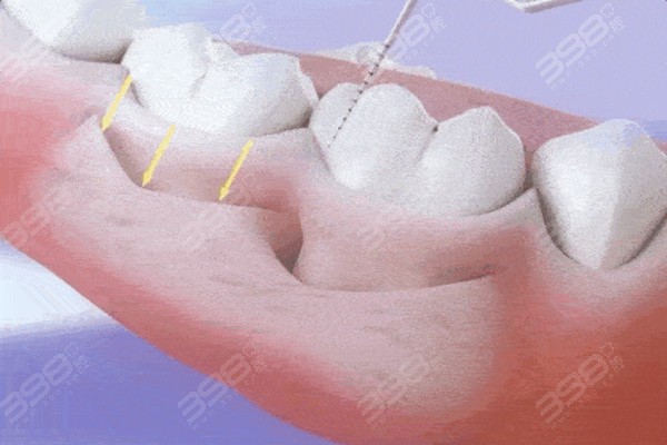 牙周刮治的治疗步骤图