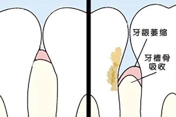 牙周刮治对牙龈有损伤吗