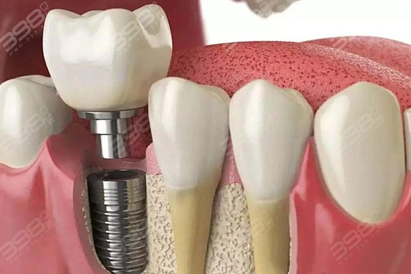 一个老牙医的10条种植牙忠告
