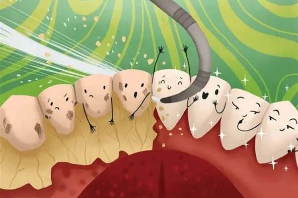 轻度牙结石症状图片分享 快来自查一下你有没有牙结石