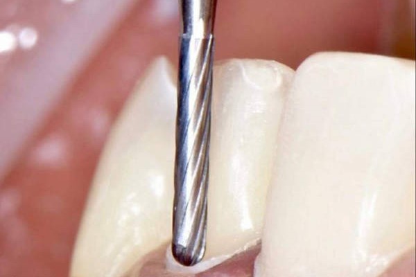 门牙被磨后的对比照片:门牙被磨后有什么影响?磨掉1mm有损害吗?