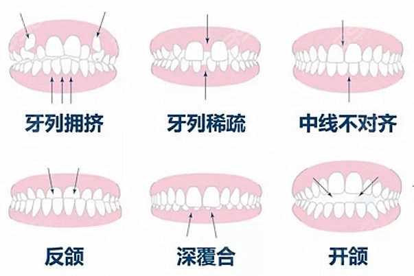 牙齿矫正深覆合图片细节解析 详看深覆合牙齿矫正前后脸型对比