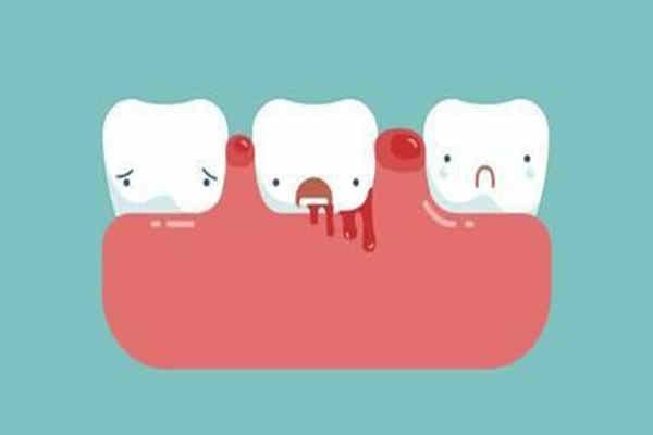 给大家展现牙龈炎症状和图片，牙龈炎治疗方法有吗？