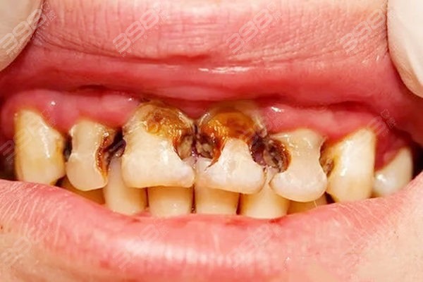 碳酸饮料对牙齿图片