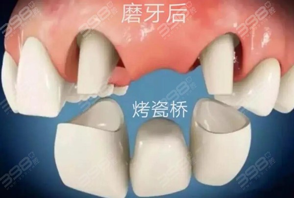 磨牙修复