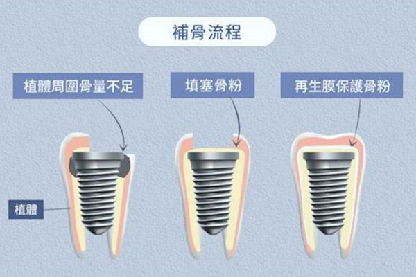 种牙填骨粉过程图解:看完种植牙填骨粉步骤后,不后悔这个决定