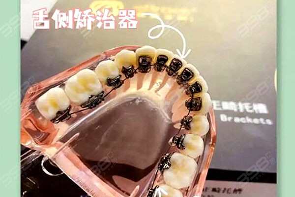 2022上海牙齿矫正价格