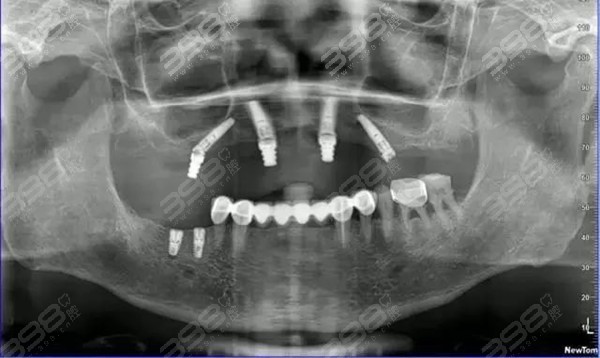 半口种植牙全过程