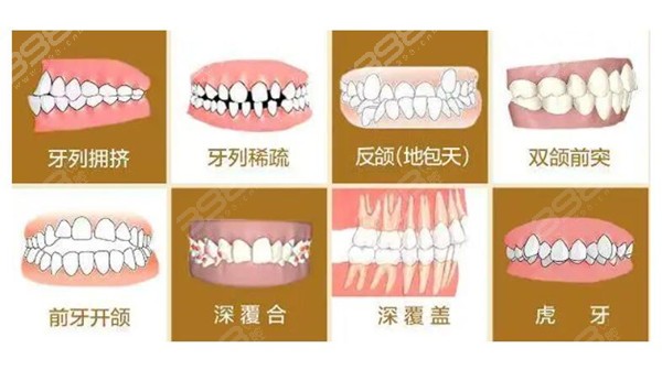 牙齿需要矫正的类型