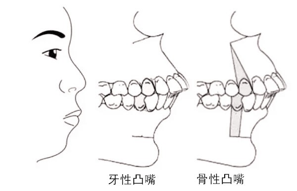 牙性凸嘴和骨性凸嘴图片对比