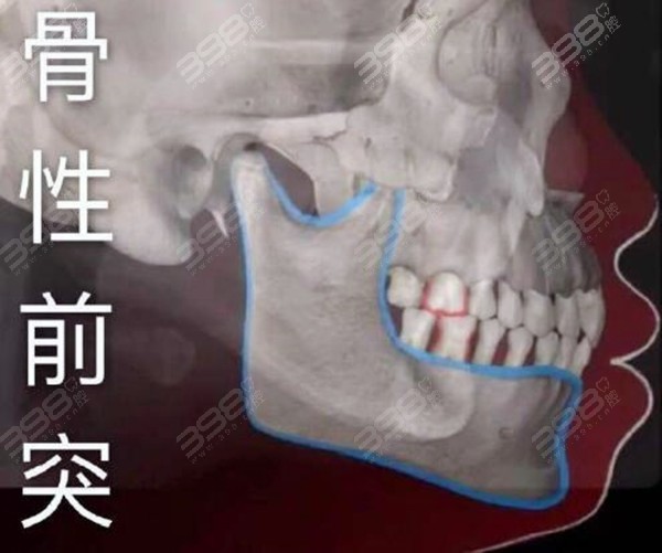 骨性凸嘴建议做正颌手术