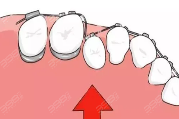 牙齿矫正只矫上面一排可以吗？