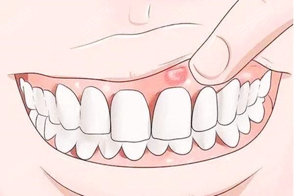 牙龈上的脓包怎么形成的