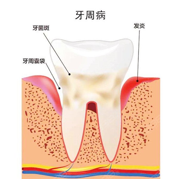 牙周炎牙槽骨吸收怎么办