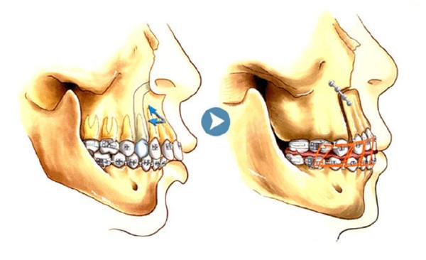 正颌手术和戴牙套有什么区别