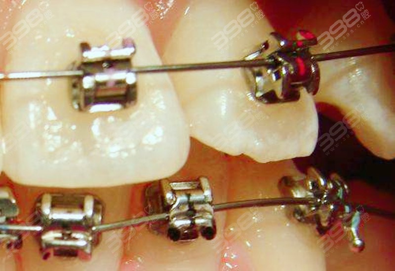学生牙齿矫正用哪种方式-金属自锁托槽矫正
