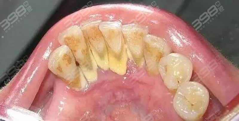 牙结石