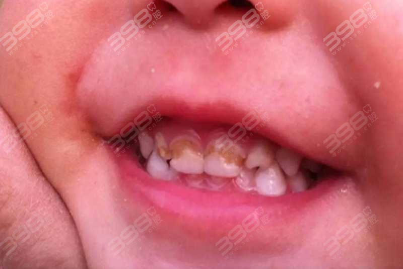 宝宝蛀牙早期症状图片：
