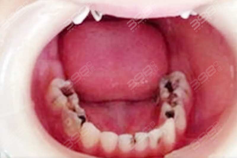 宝宝龋齿是什么原因造成的？