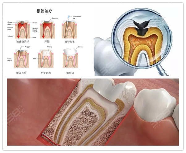 如何判断牙齿是否需要根管治疗