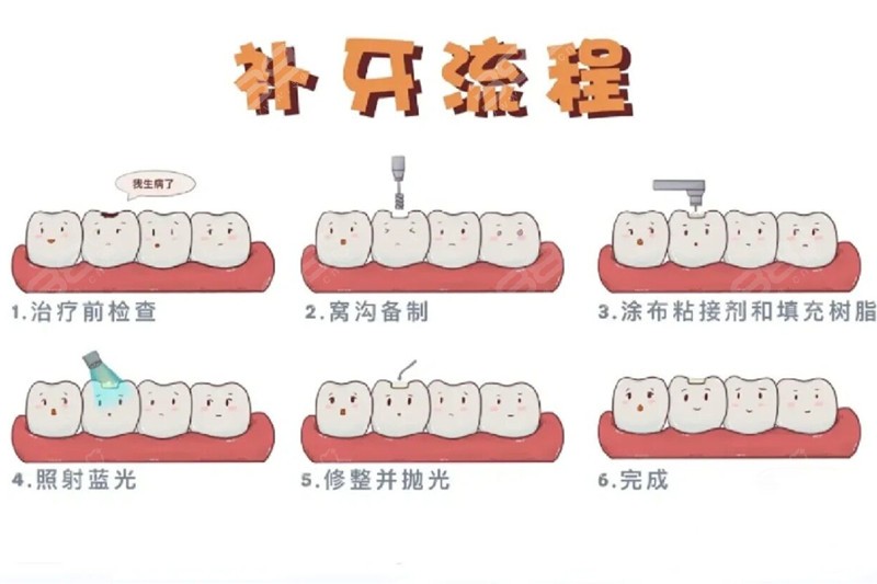 树脂补牙流程