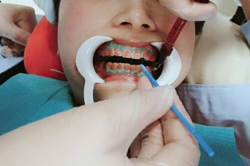四环素牙和氟斑牙区别图片,分清楚氟斑牙or四环素牙后该怎样才能变白?