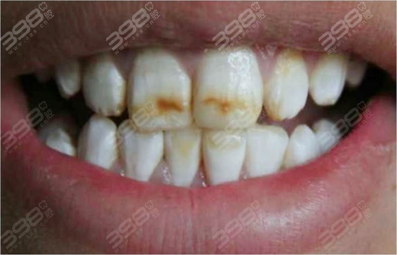 氟斑牙不同程度照片-中度