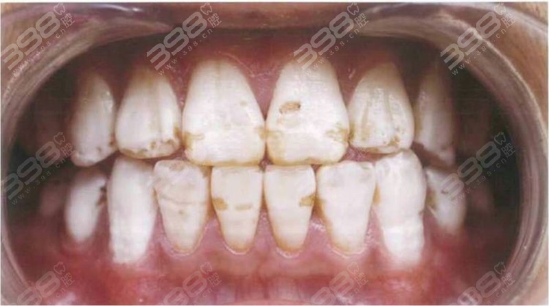 氟斑牙不同程度照片