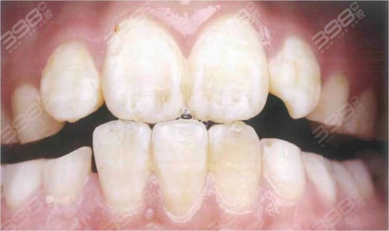 氟斑牙不同程度照片-轻度